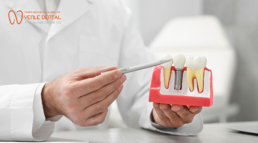 trồng implant